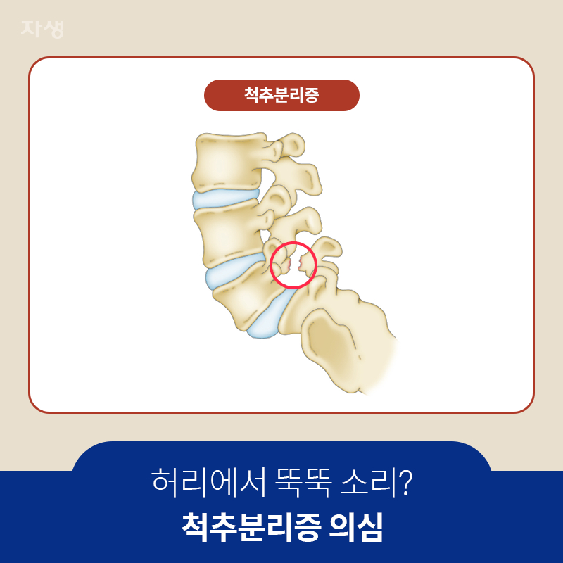 참고 이미지 : 허리에서 뚝뚝 소리? 척추분리증 의심 | 자생한방병원·자생의료재단